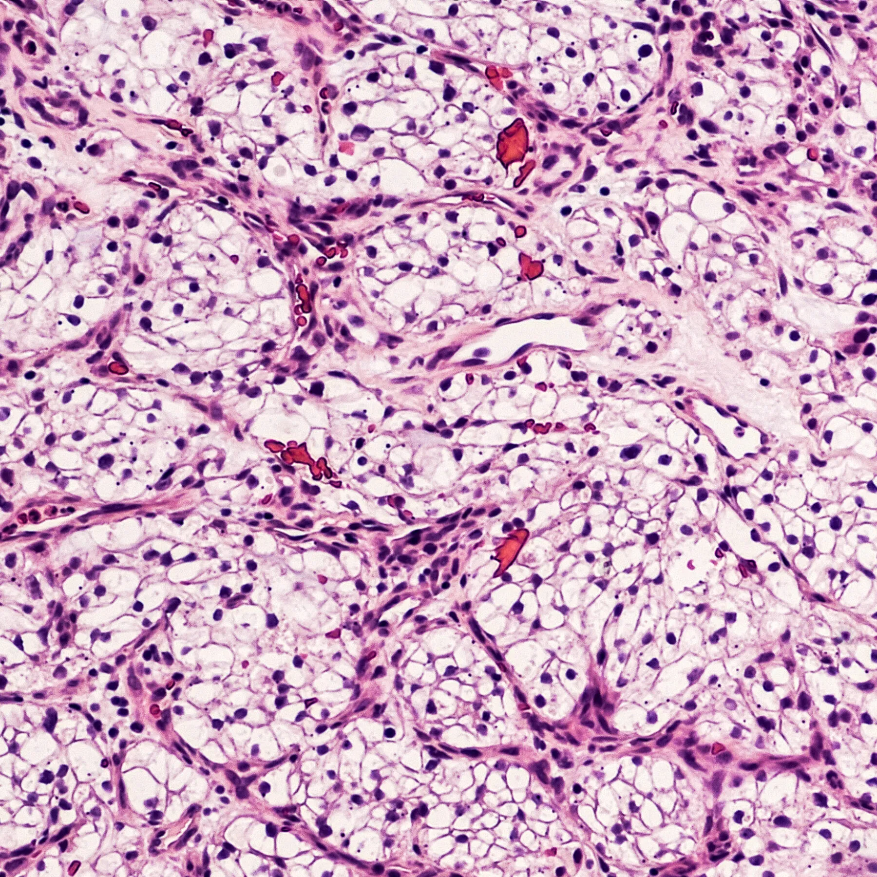 Microscopic image of clear cell carcinoma, the most common type of renal cell carcinoma