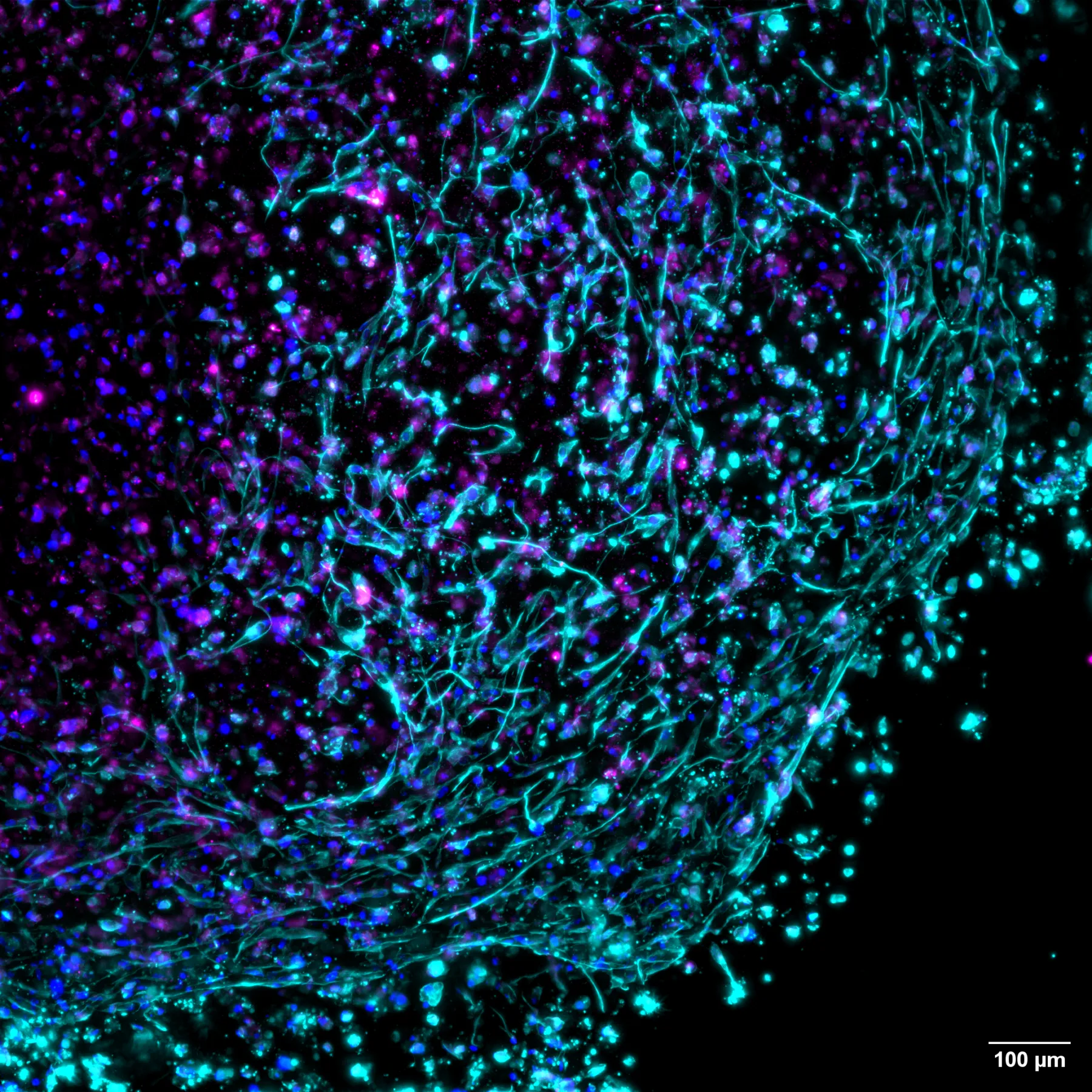 3D-bioprinted Tumour