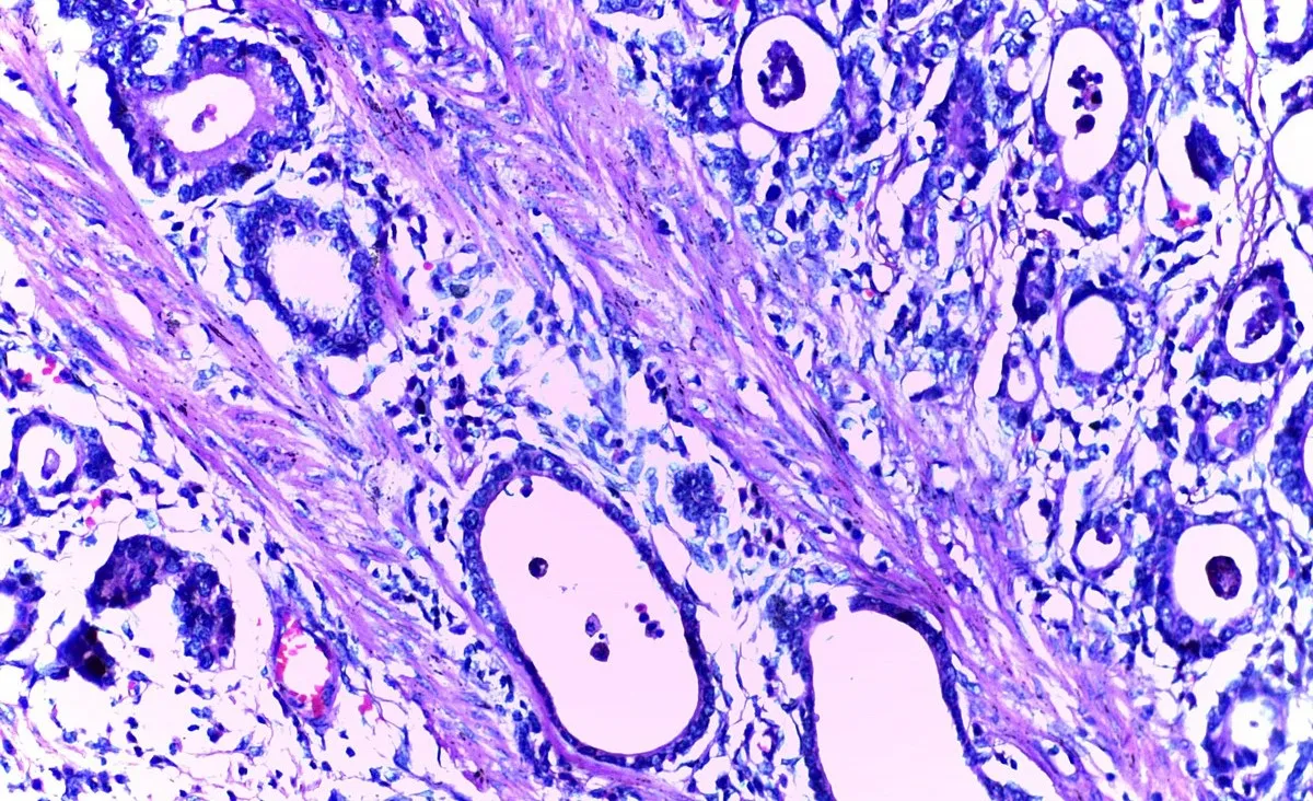 stained microscopic sample of stomach cancer cells