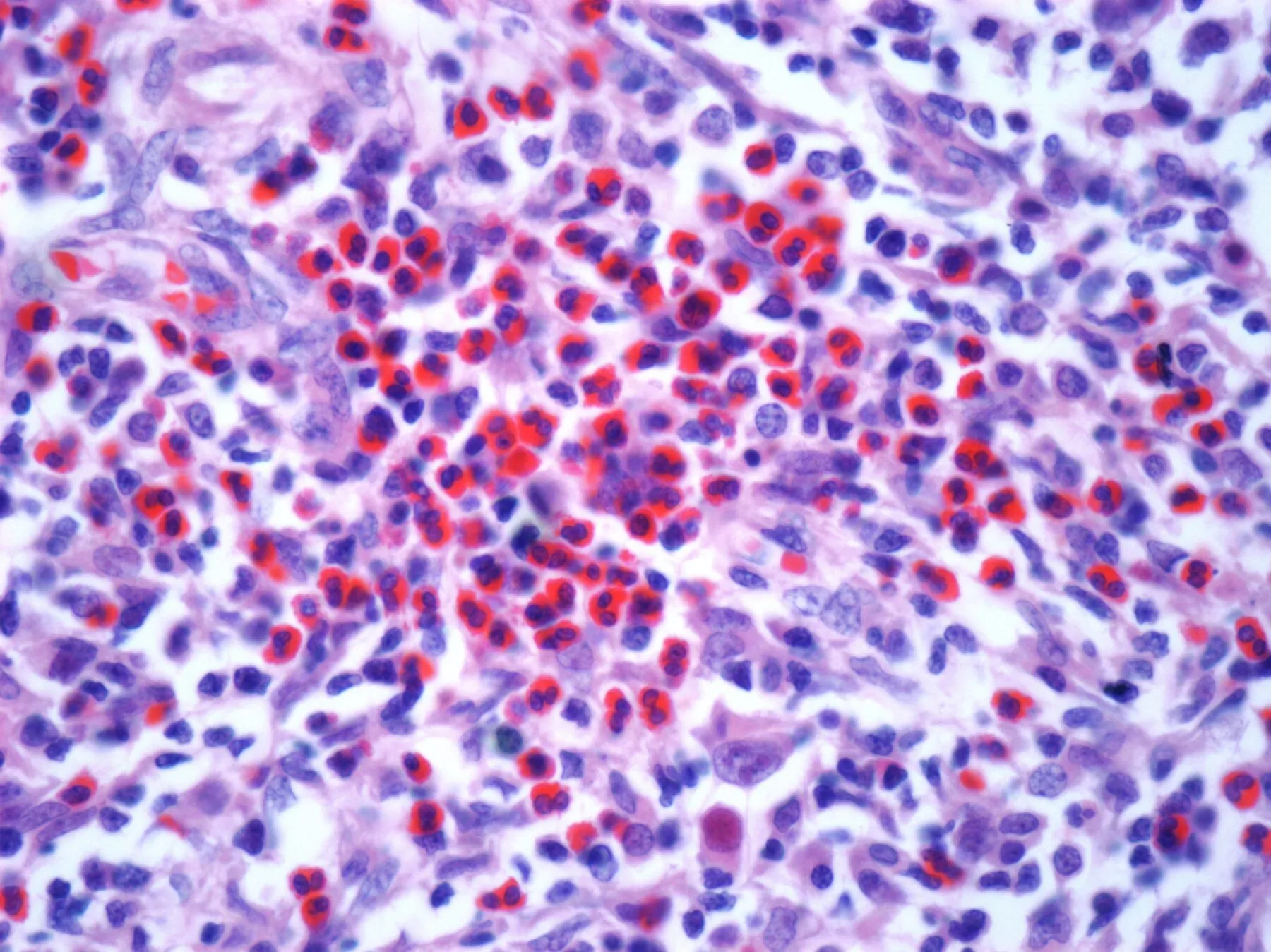 Microscopy image of Hodgkin's lymphoma