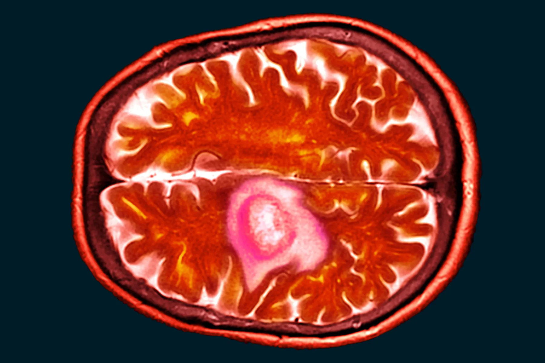 CT scan of a glioblastoma brain tumour highlighted in one section of the brain.