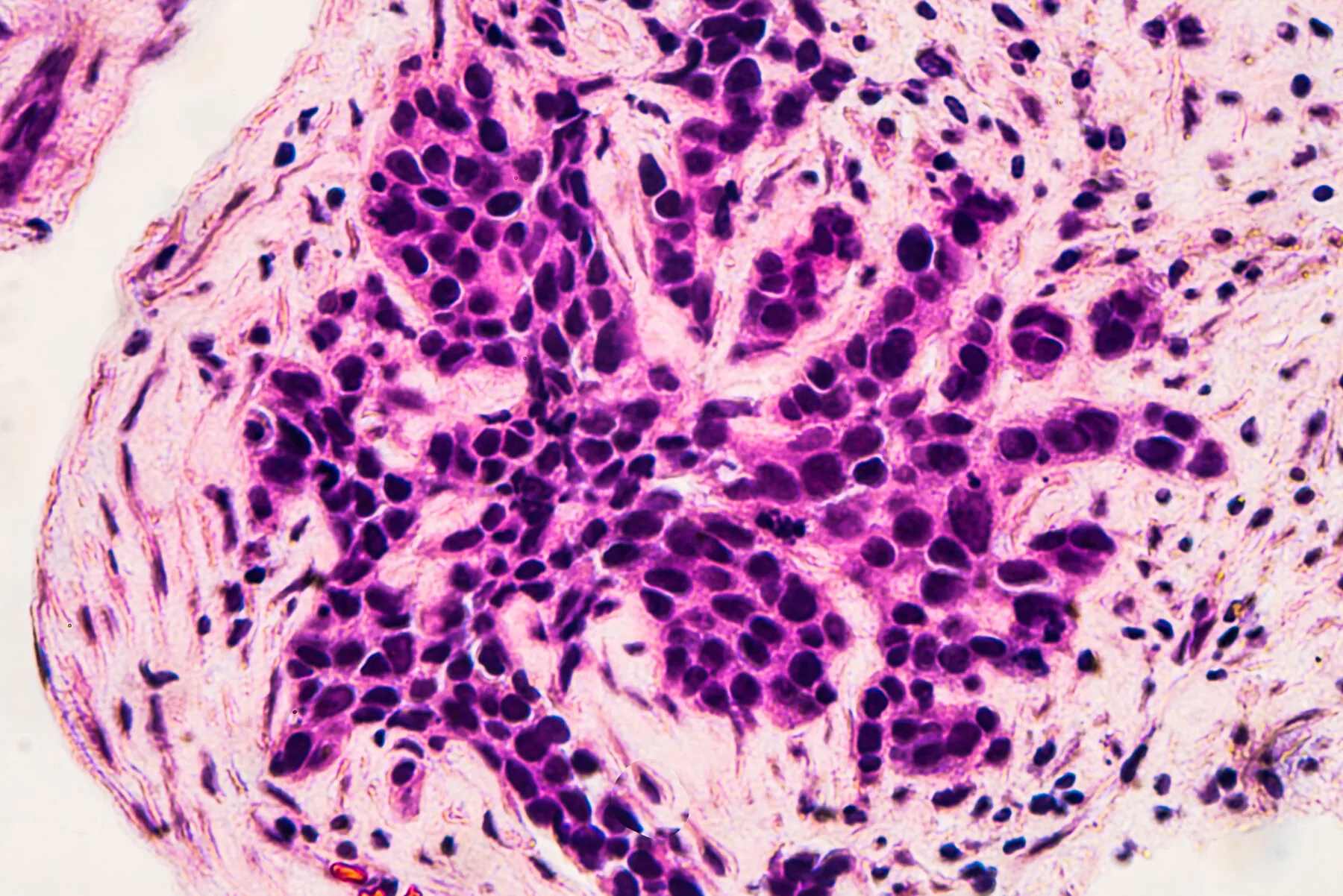 Microscopic image of core biopsy for infiltrating (invasive) ductal carcinoma, detected by screening mammogram