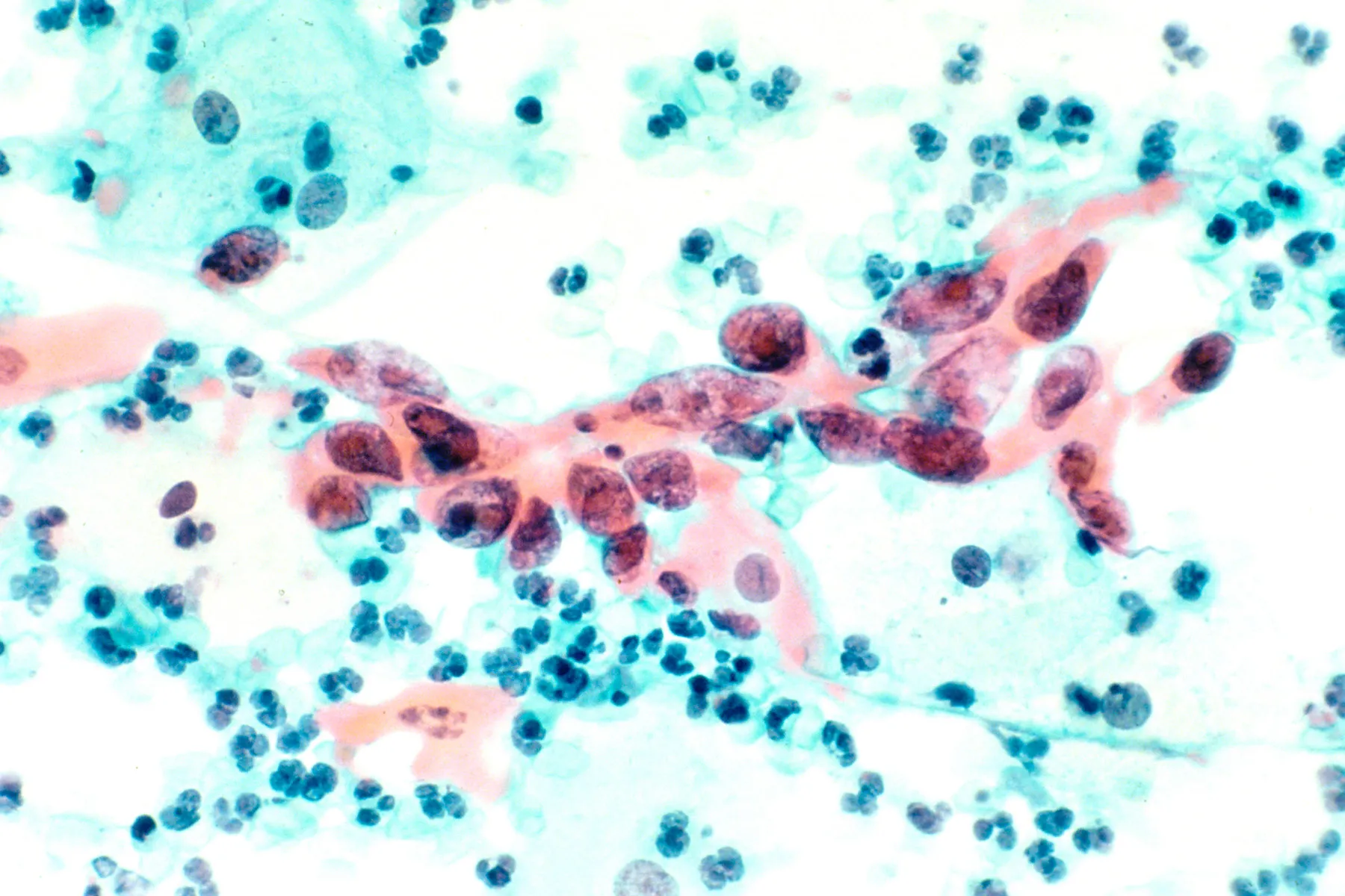 A magnified image of squamous cell carcinoma, the most common type of cervical cancer.