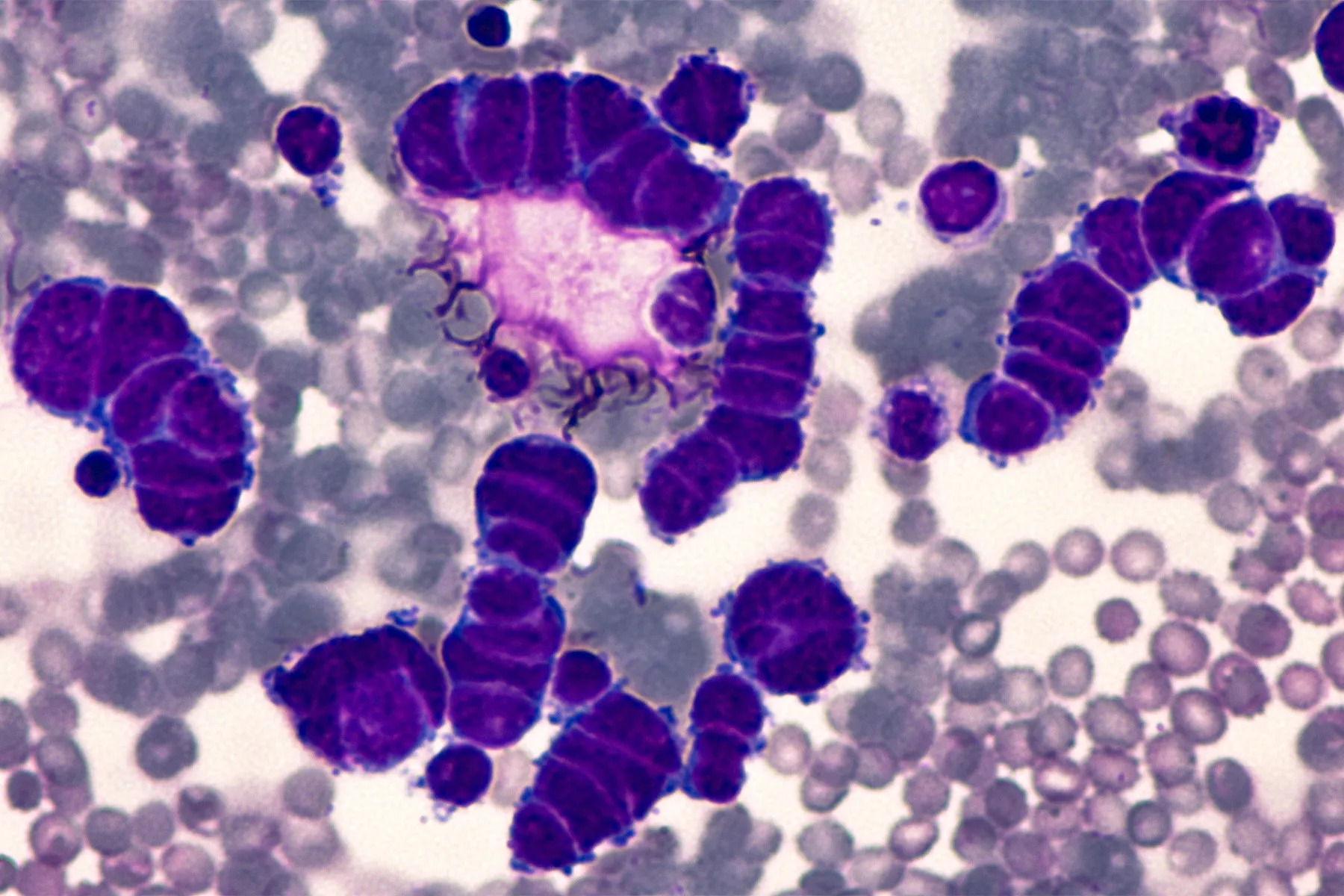 Microscopic images of pleural fluid cytology of a small cell oat cell carcinoma