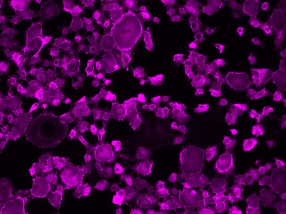 Kidney cancer cell line, A704, with fluorescent labelling showing over-expression of a transmembrane protein associated with clear cell renal cell carcinoma.