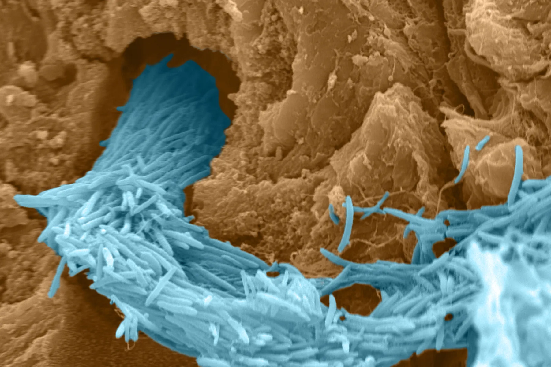 Salmonella bacteria (rod-shaped organisms coloured blue) in a bowel cancer tumour (coloured beige). The bacteria looks like it is rushing into a hole in the tumour tissue.