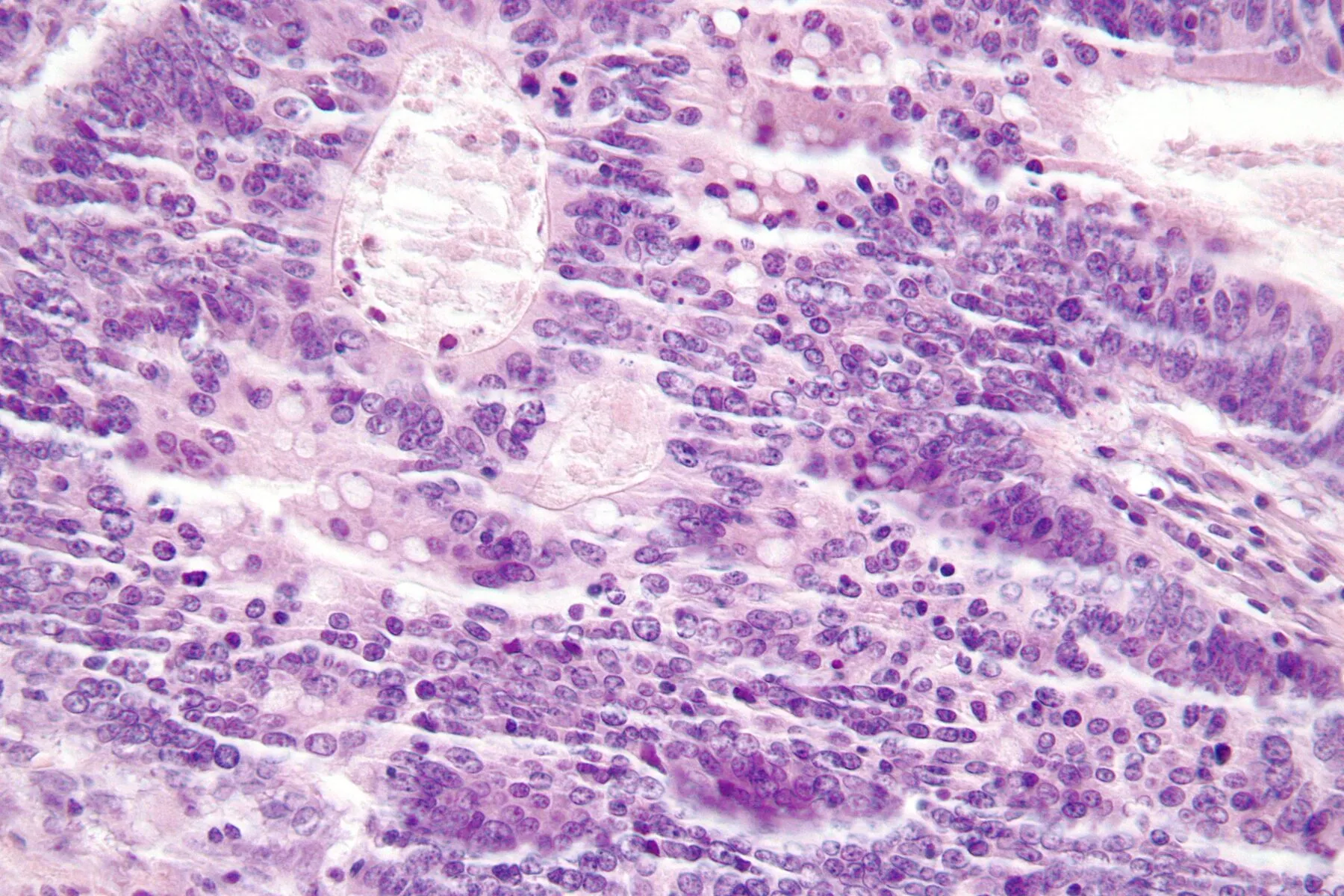 A microscope image showing immune cells in bowel cancer.