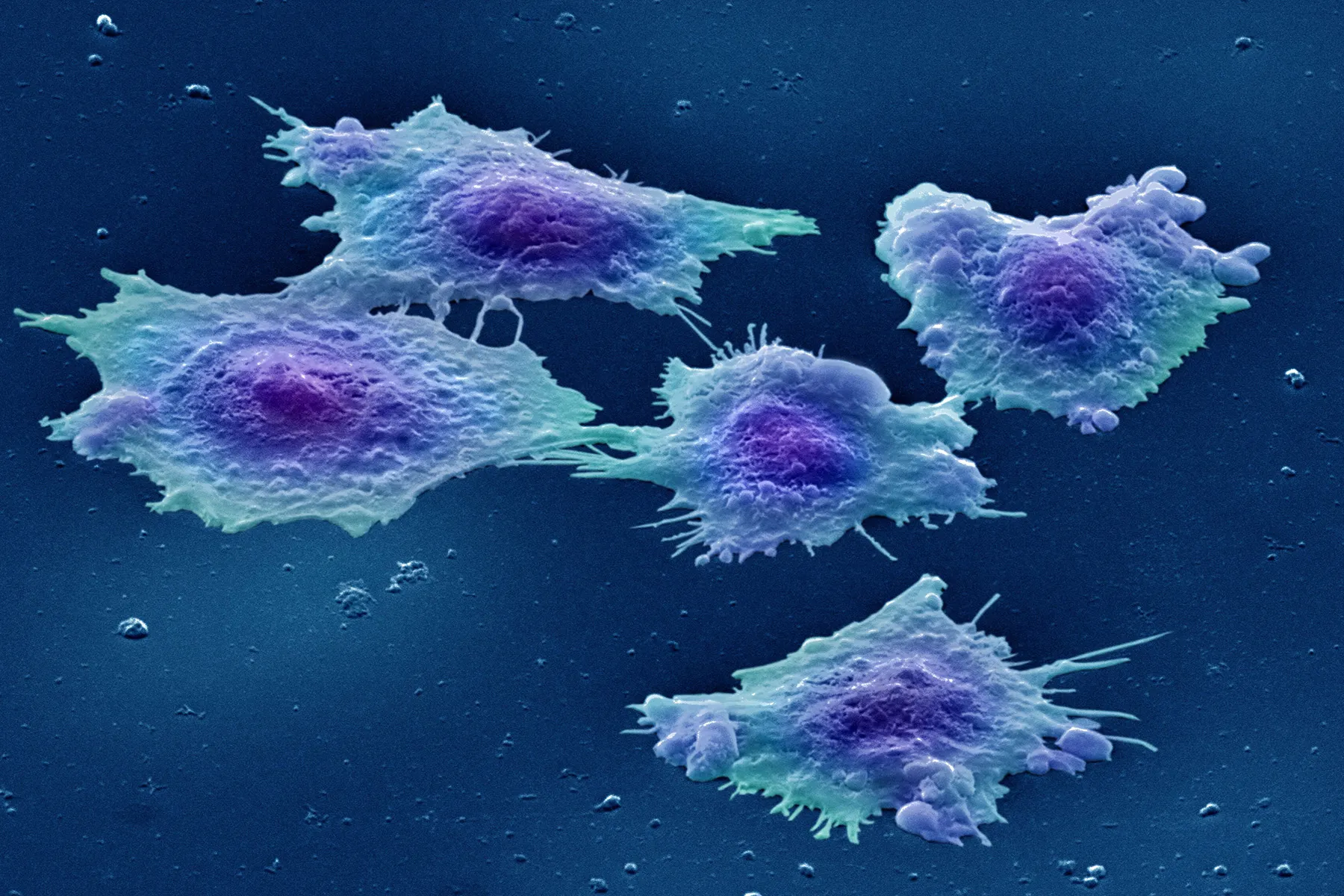 Lab-grown bowel cancer cells seen through a microscope. They are colour-enhanced and appear blue.