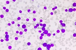 A microscopic image of acute lymphoblastic leukaemia cells among healthy blood cells. The leukaemia cells are larger and coloured purple.