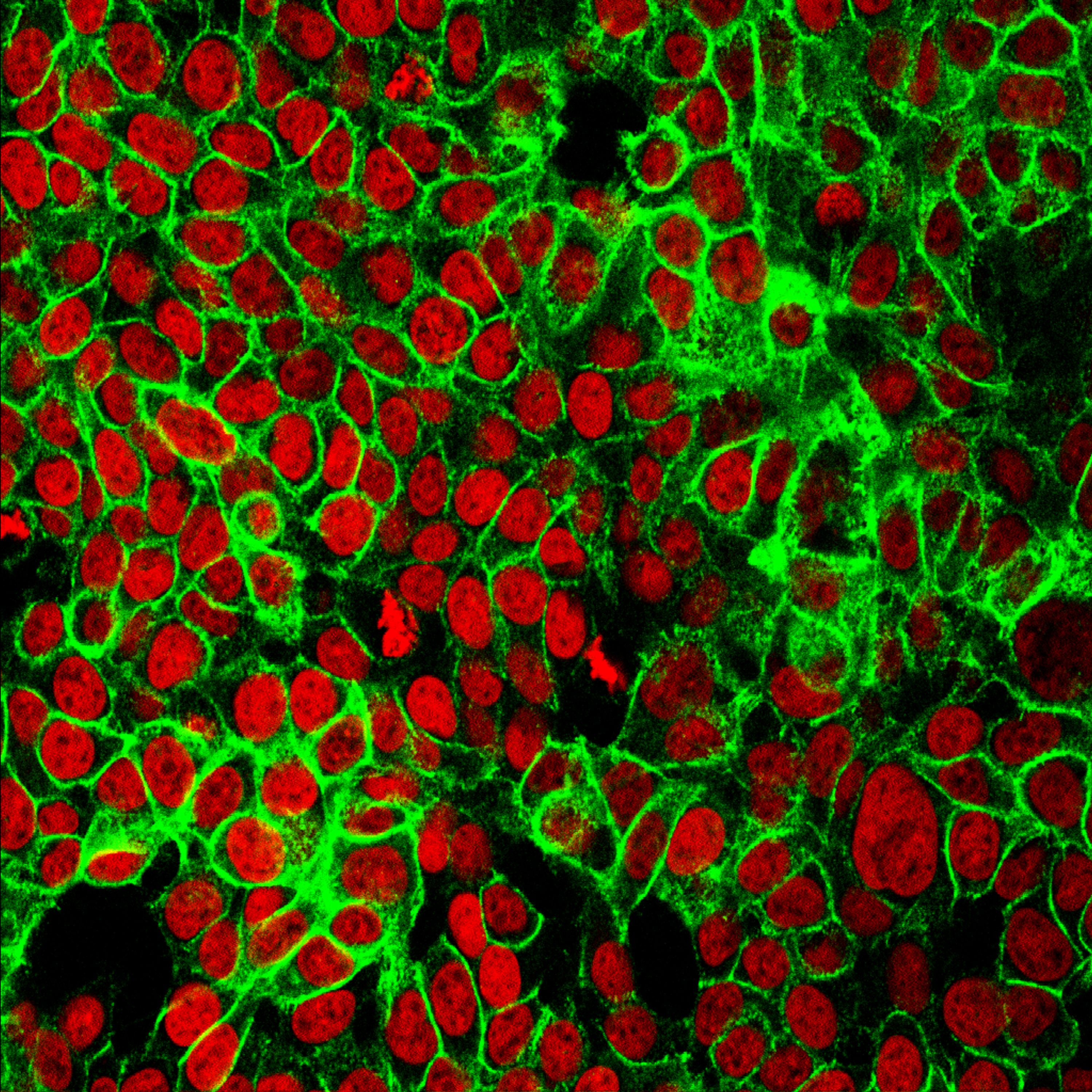 Microscope image of human colon cancer cells with the cell nuclei stained red and the protein E-cadherin stained green
