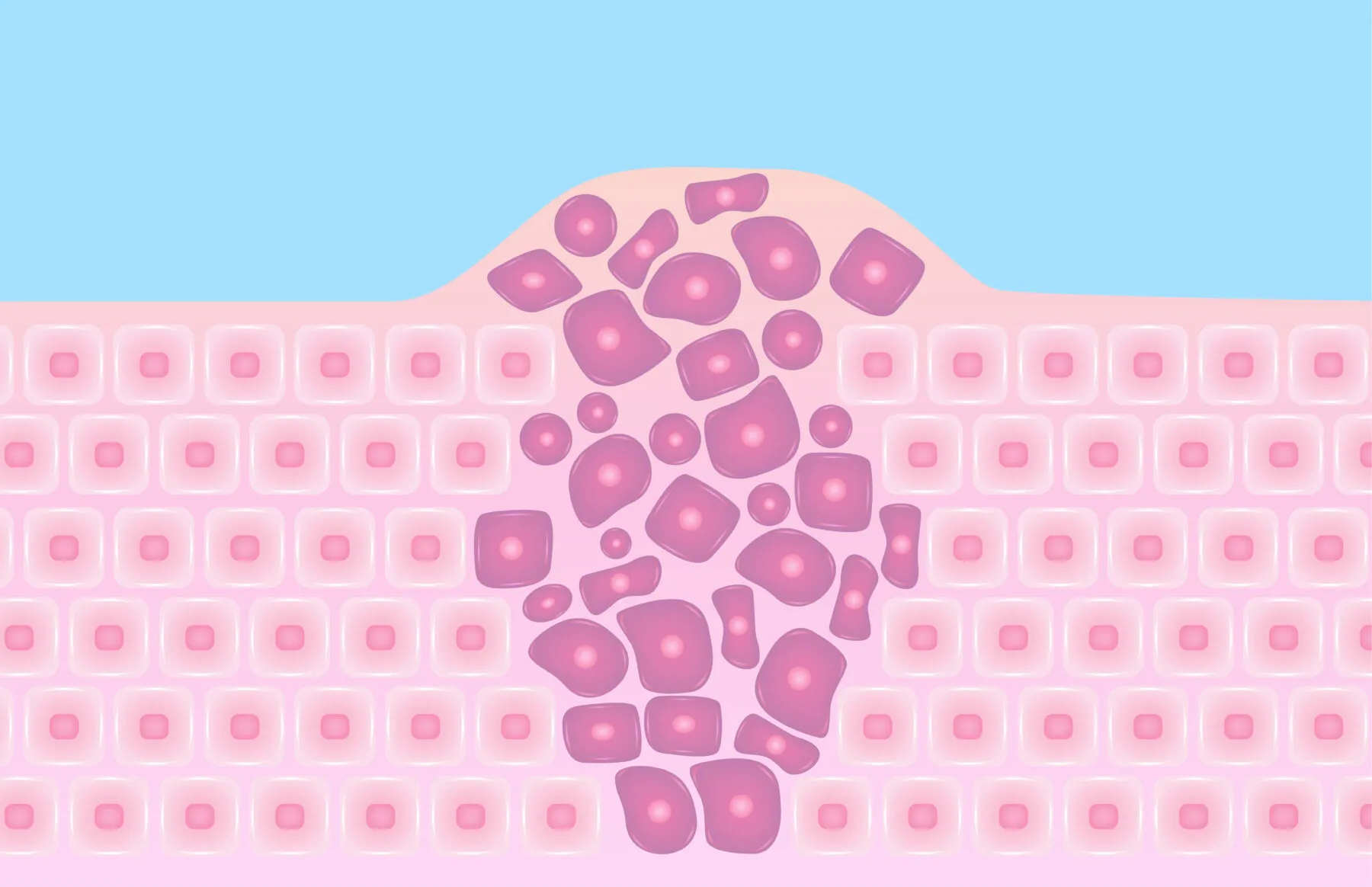 Skin cancer cells in a growing tumour