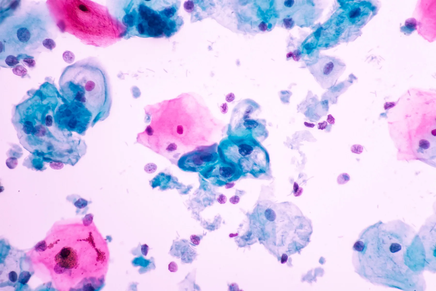 A microscope image of cervical cells that have changed shape and size because of HPV infection.
