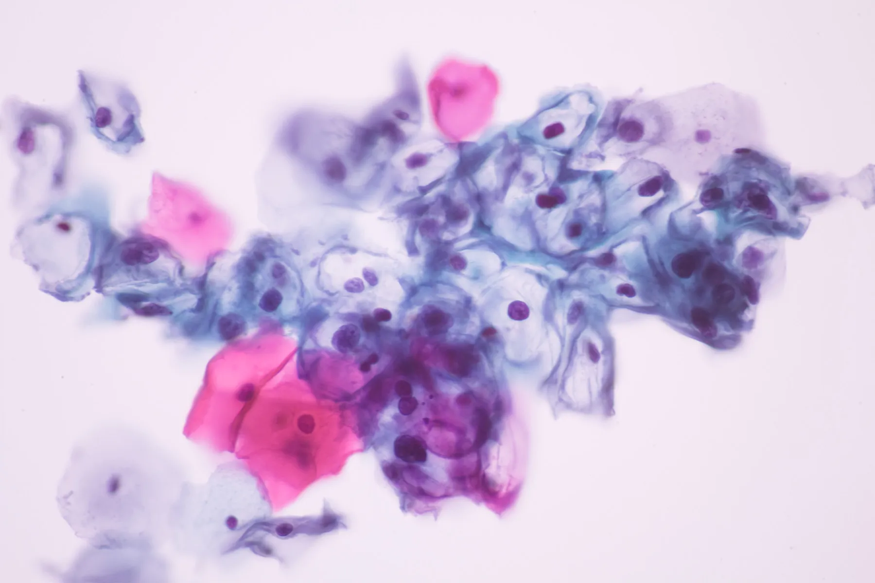 A microscope image of cervical cells that have changed shape and size because of HPV infection. Most of the cells are blue, but some are pink or purple.
