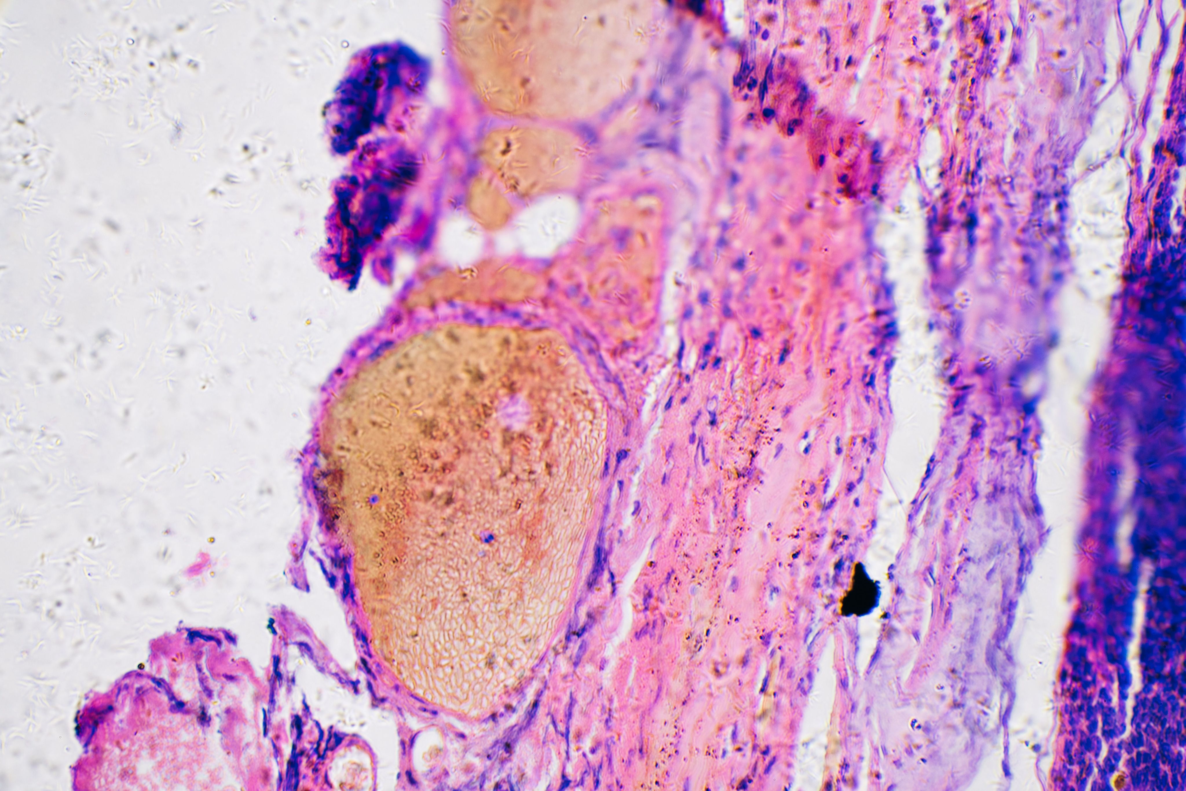 Tissue biopsy showing melanoma cells