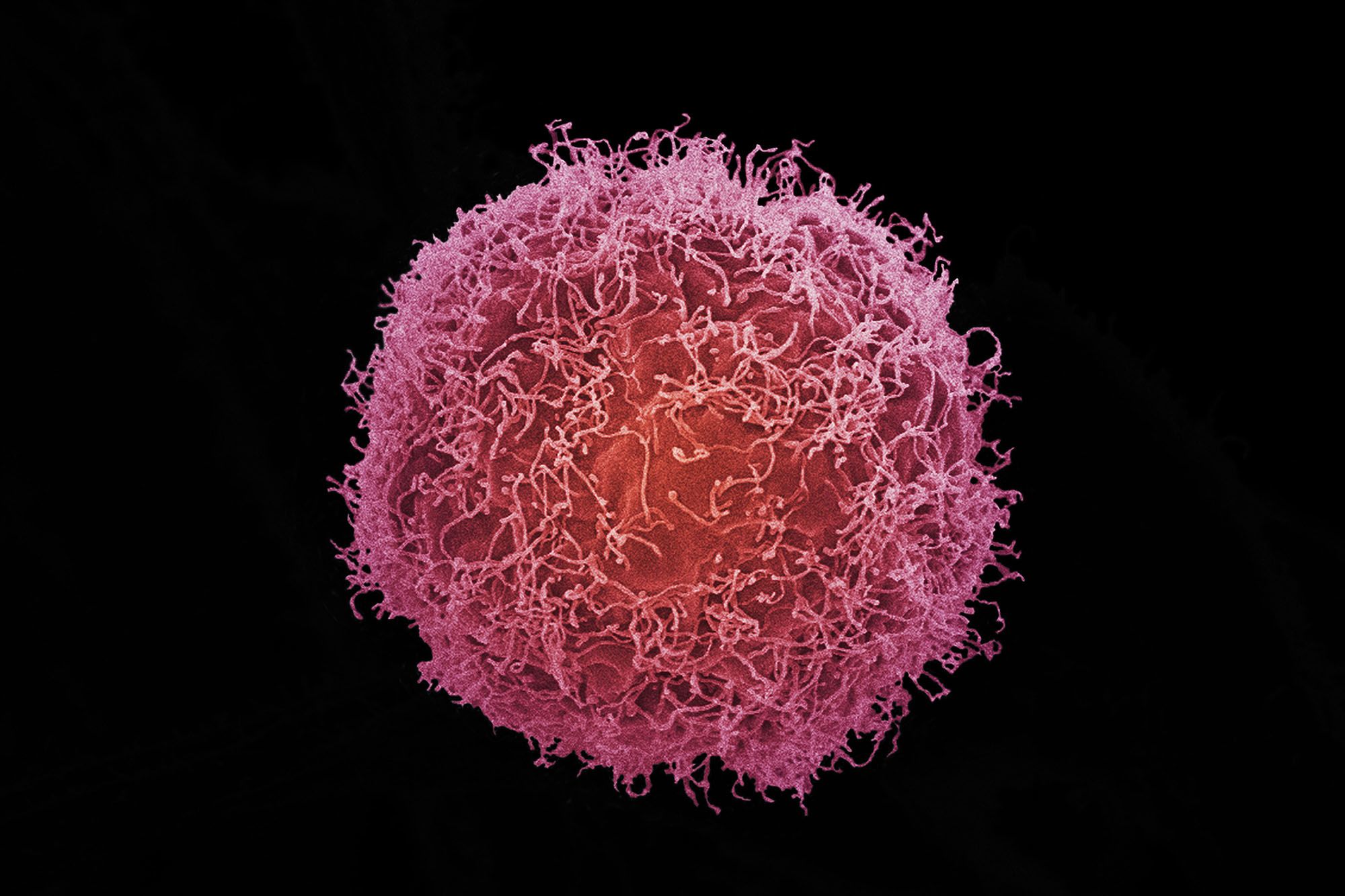 A skin cancer cell