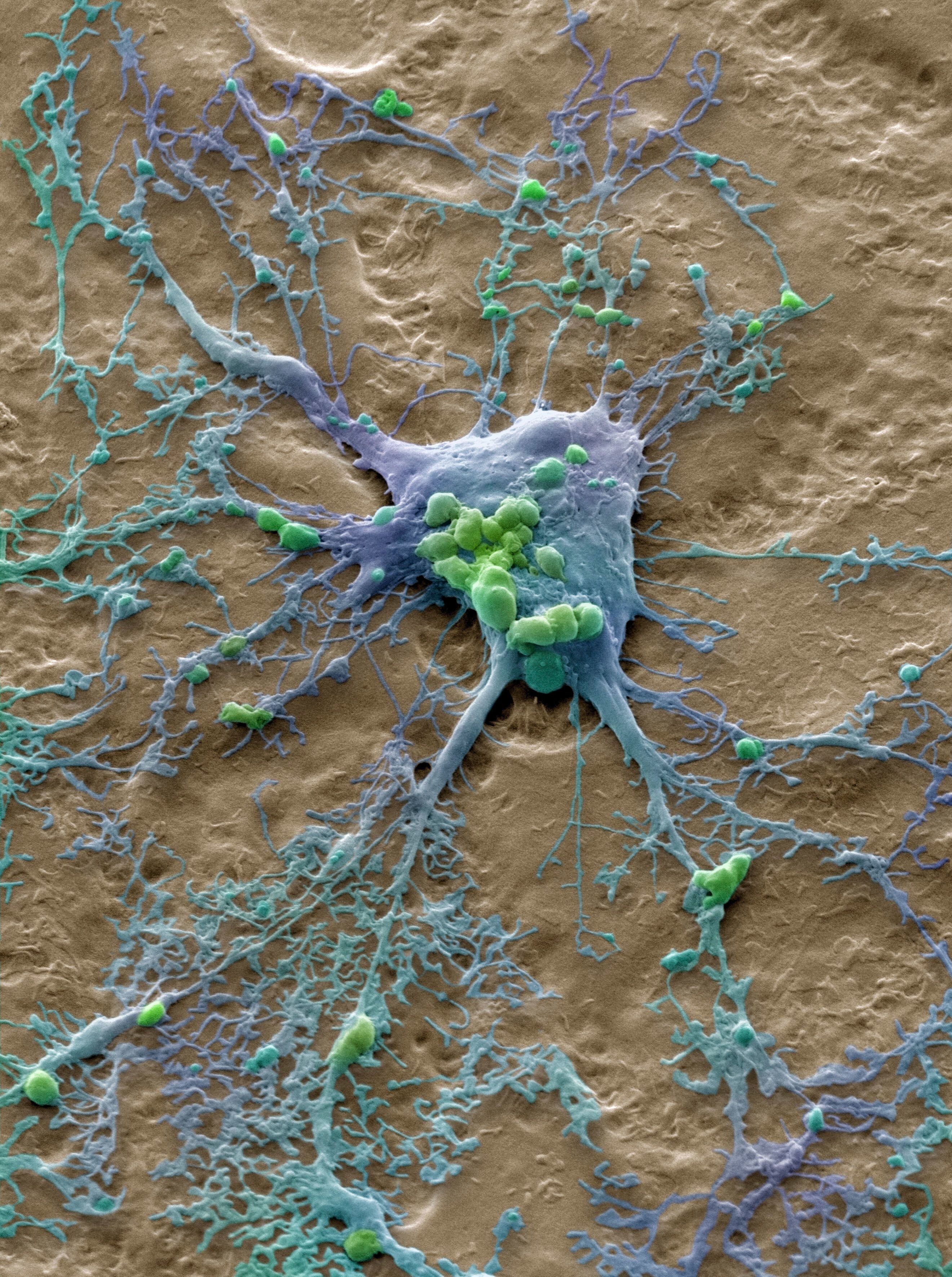 A cell from a squamous cell carcinoma seen through a microscope.