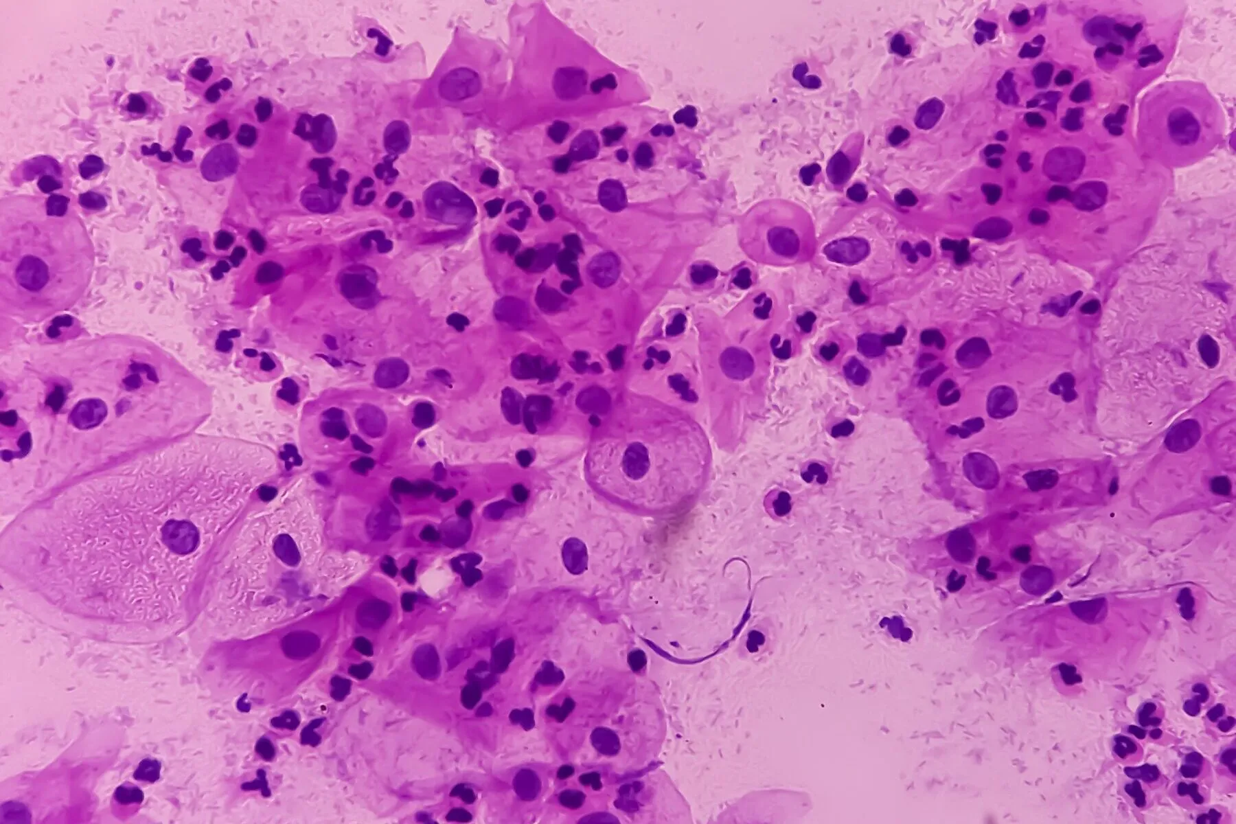 A magnified image of squamous cell carcinoma, the most common type of cervical cancer.