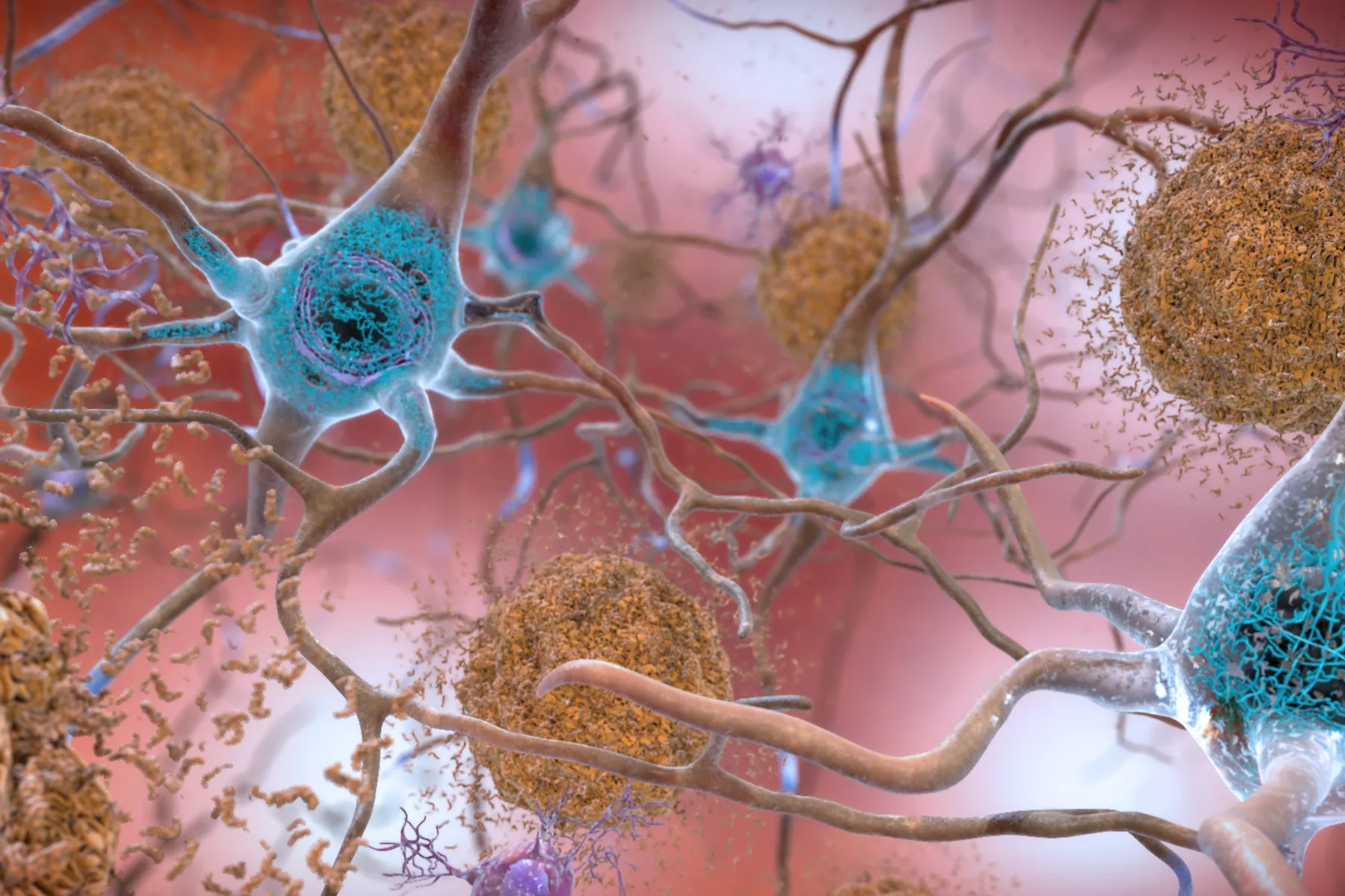 A computer-generated image showing what happens in the brain to cause dementia. Brown proteins are clumping together between blue neurons and disrupting cell function