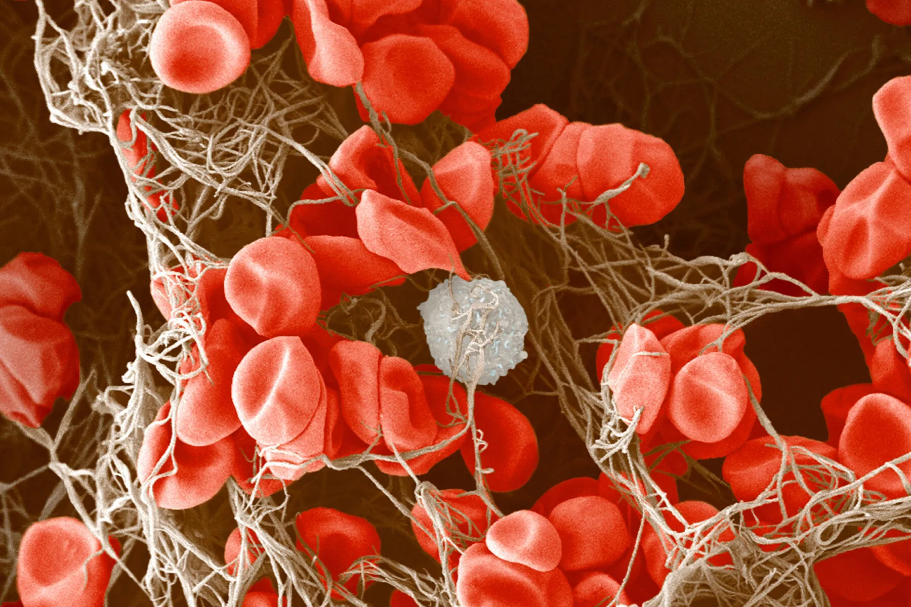 A microscopic image of a blood clot. There are many red blood cells and a single white blood cell held together in a meshwork of brown fibrin.