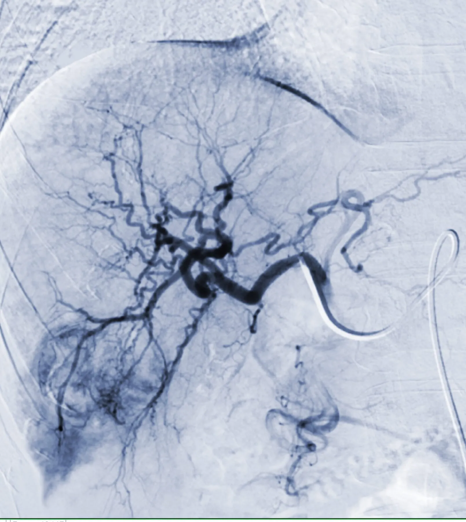 Transarterial,Chemoembolization,(tace),