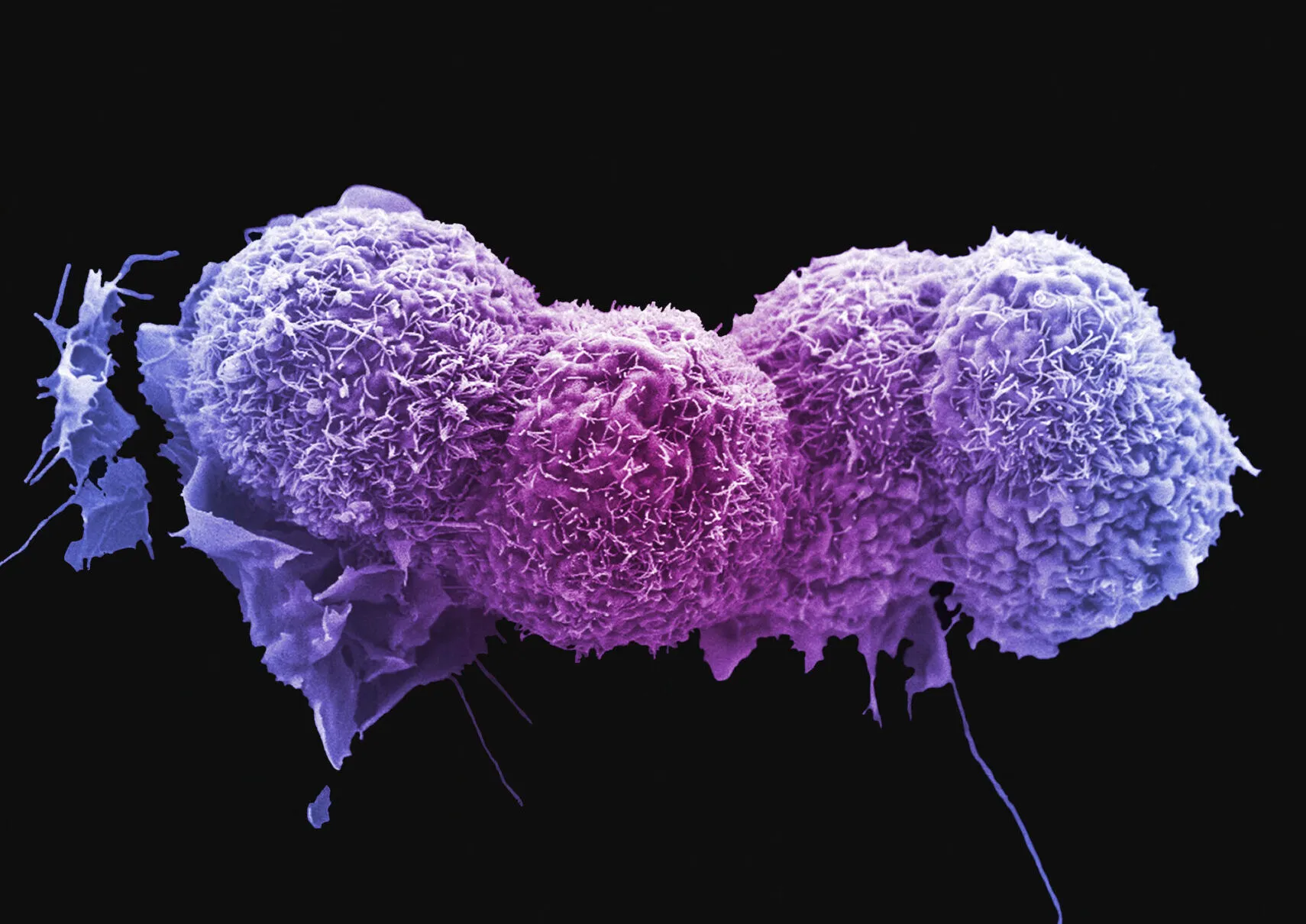 An electron micrograph of 3 purple coloured lung cancer cells.