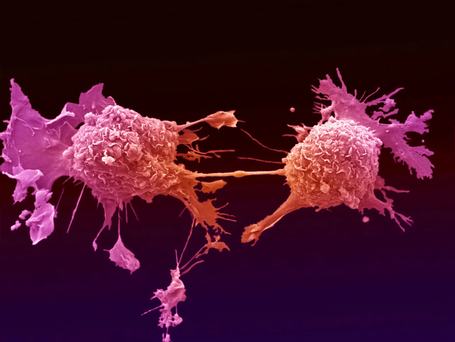 A microscopic image of two lung cancer cells dividing, held together by a very thin bridge of cytoplasm.