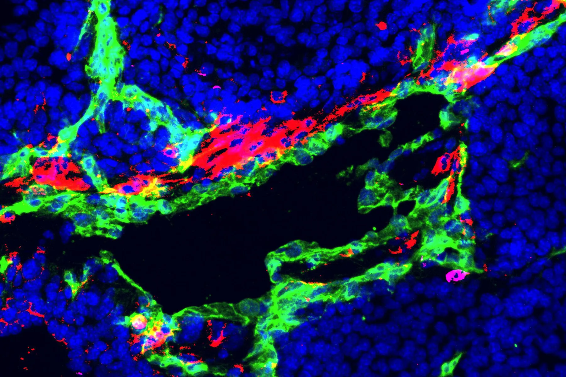 A microscopic image showing a tumour sample with different types of cells in different colours. Macrophages (red) are producing HO-1 near blood vessels (green) to keep T cells out of tumour tissue. Many of the blue cells in this image are cancer cells. There are small pockets of T cells highlighted in magenta.