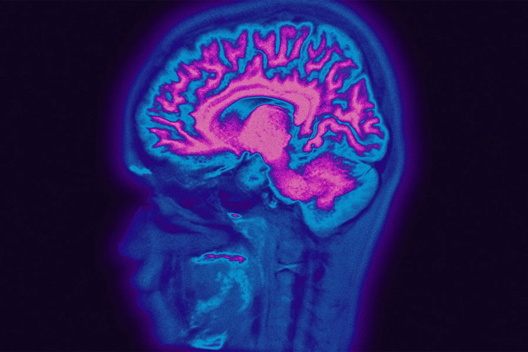 An MRI image of a brain.