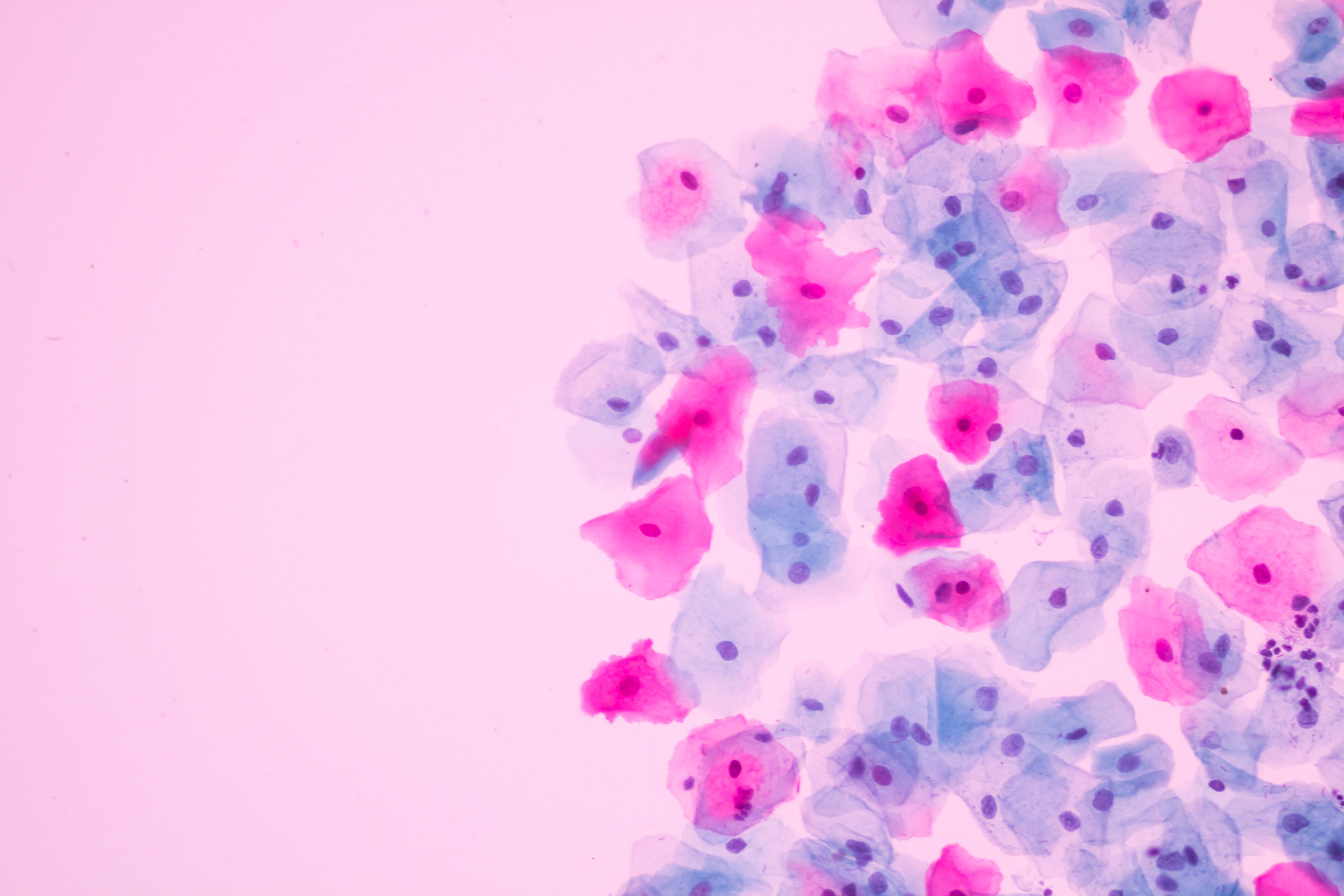 Cervical cells as seen stained under the microscope