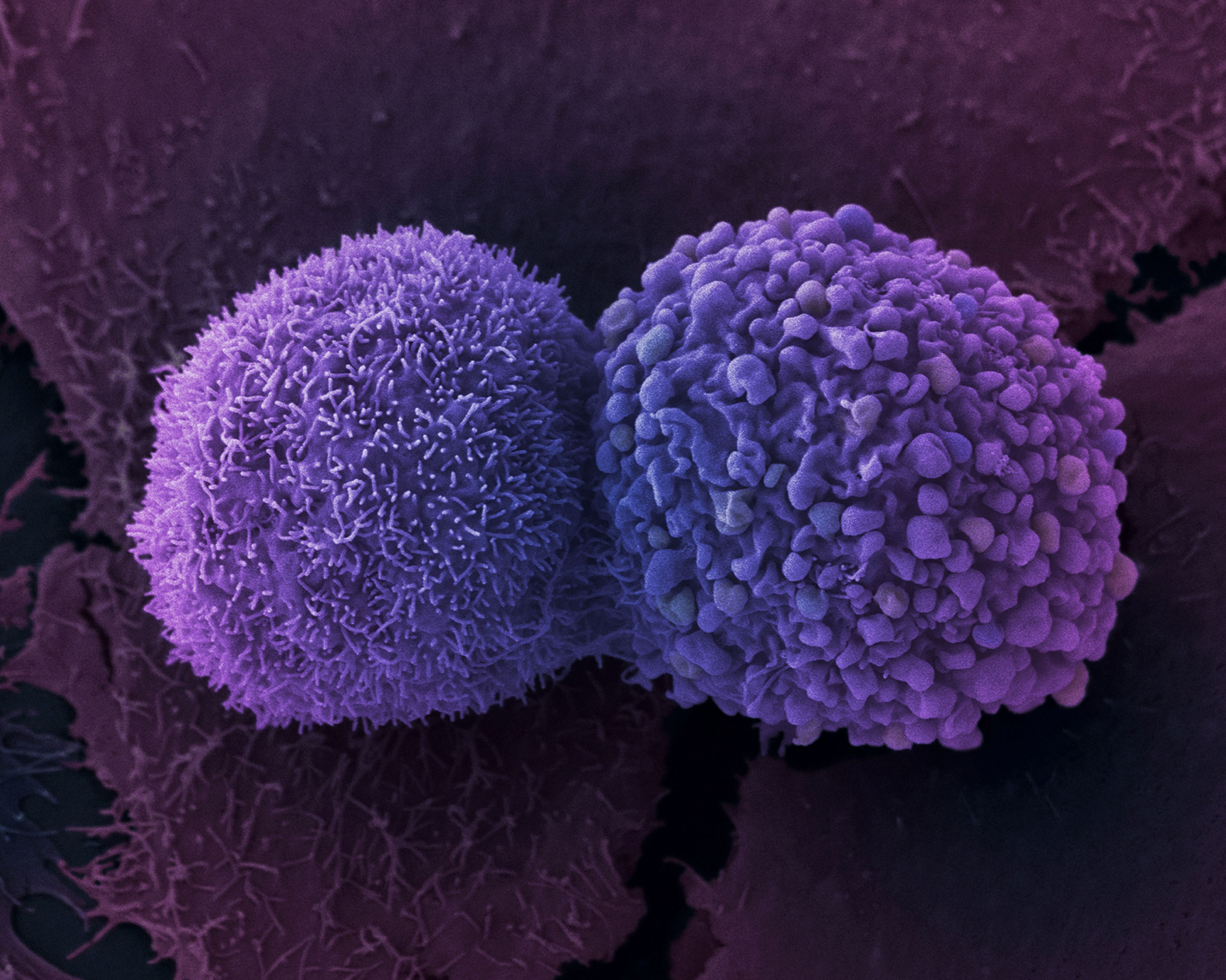 A microscope image of two conjoined lung cancer cells, both coloured purple. The cell on the left appears to be covered in thin, hair-like protrusions. The cell on the right looks more lumpy.