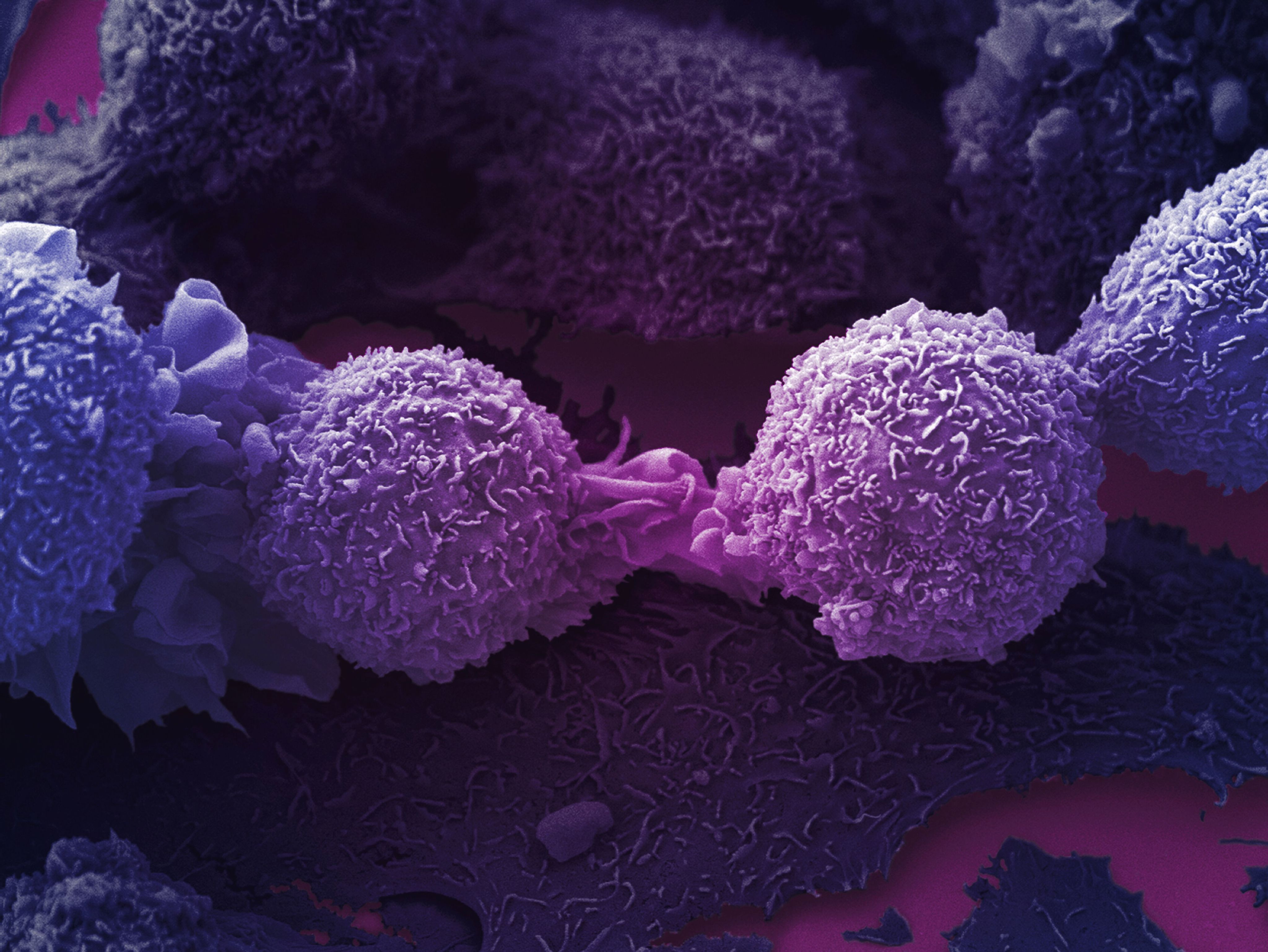 A microscope image of lung cancer cells in the last stages of dividing. The cells are coloured purple and appear rough, almost as if they were coated in desiccated coconut. 