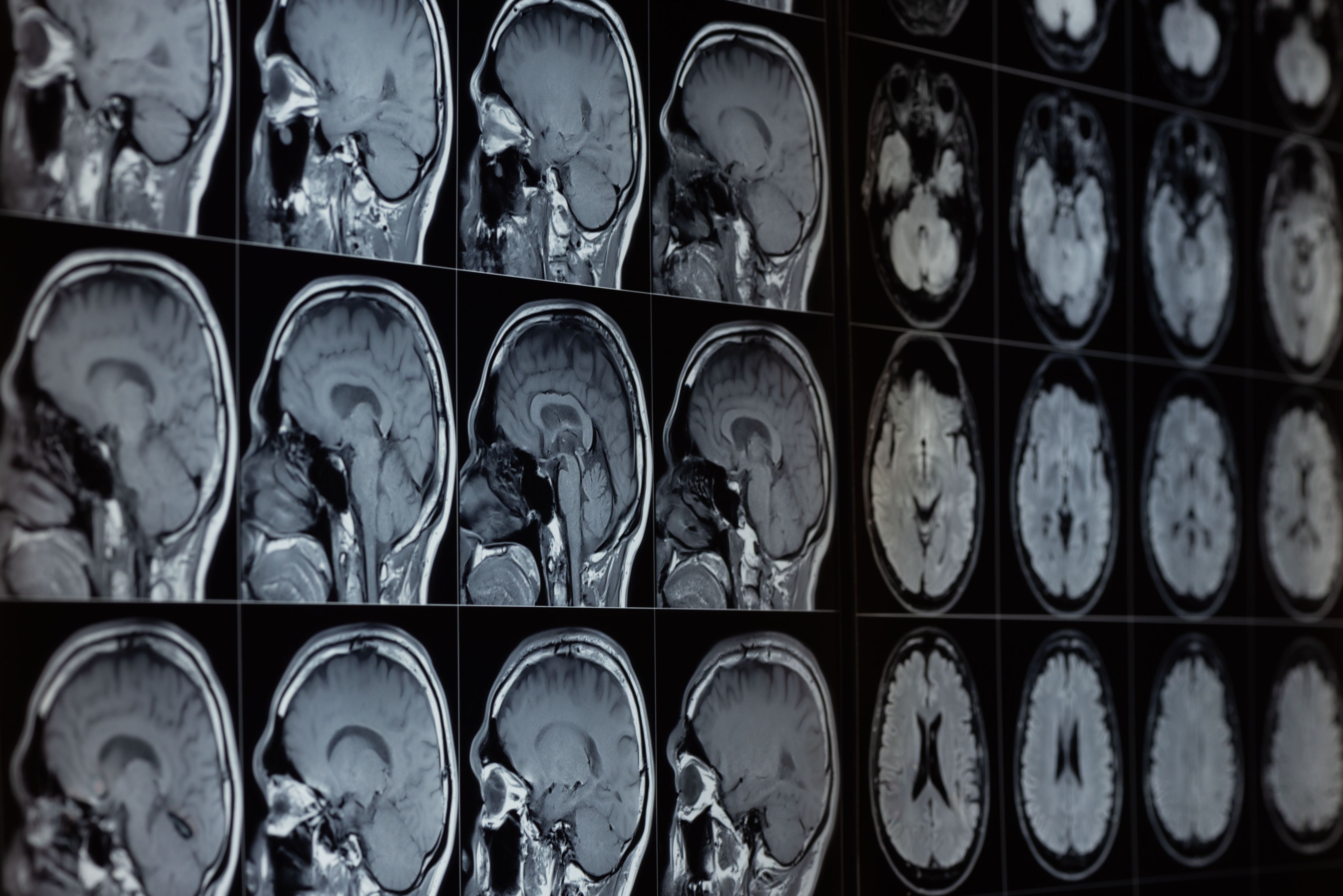 A screen showing MRI brain scan images from multiple areas and angles.