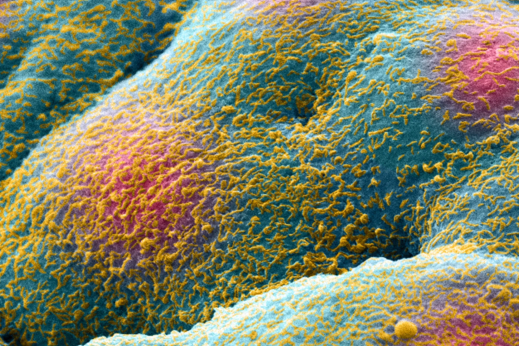 Prostate cancer cell spheroid, SEM.