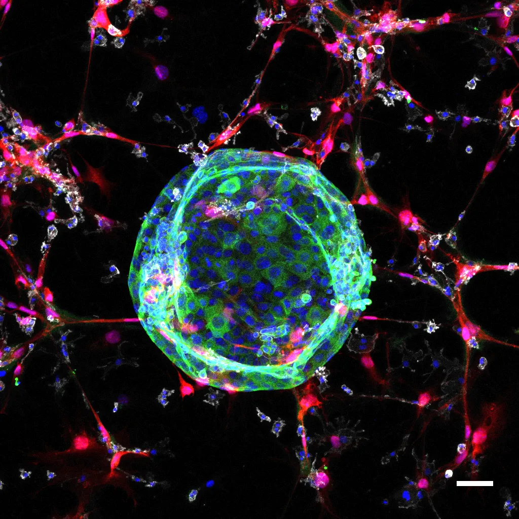 Bowel cancer organoid. Credit: Dr Christopher Tape.