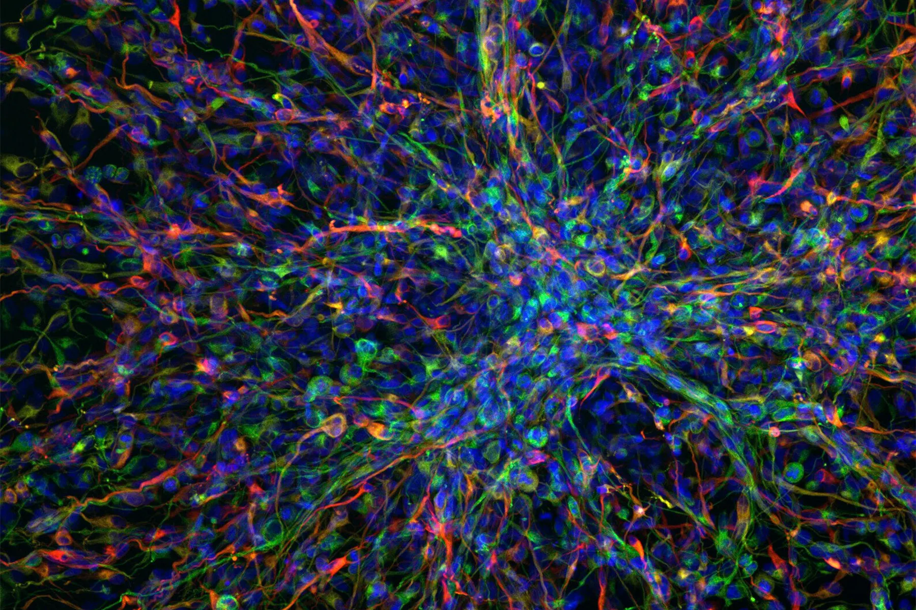 Confocal micrograph of highly invasive tumour cells derived from a rare paediatric brain tumour.