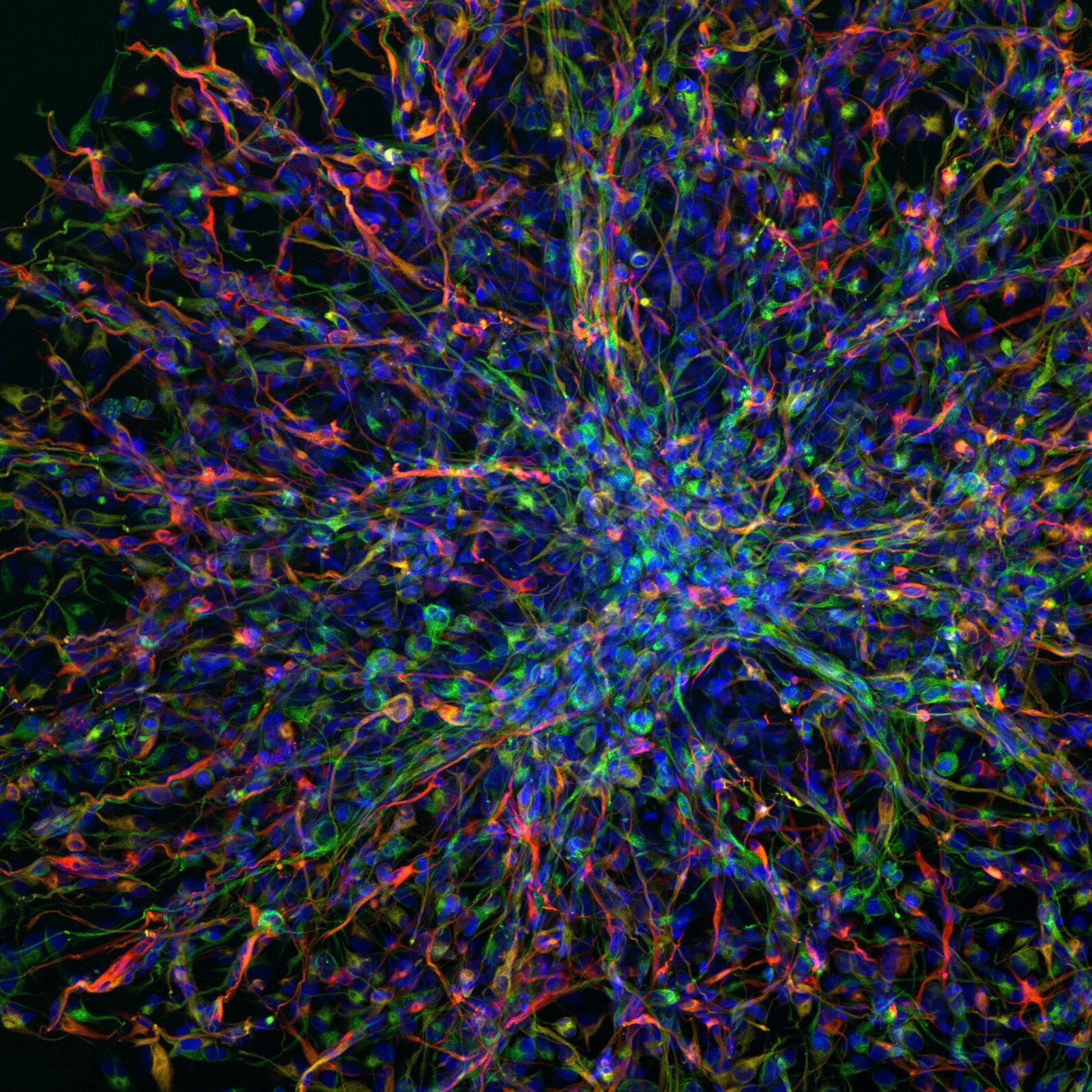 Paediatric glioblastoma cells seen through a confocal microscope.