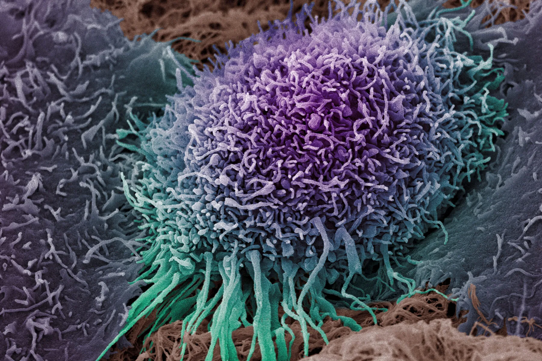 Human oral squamous cell carcinoma cell, SEM