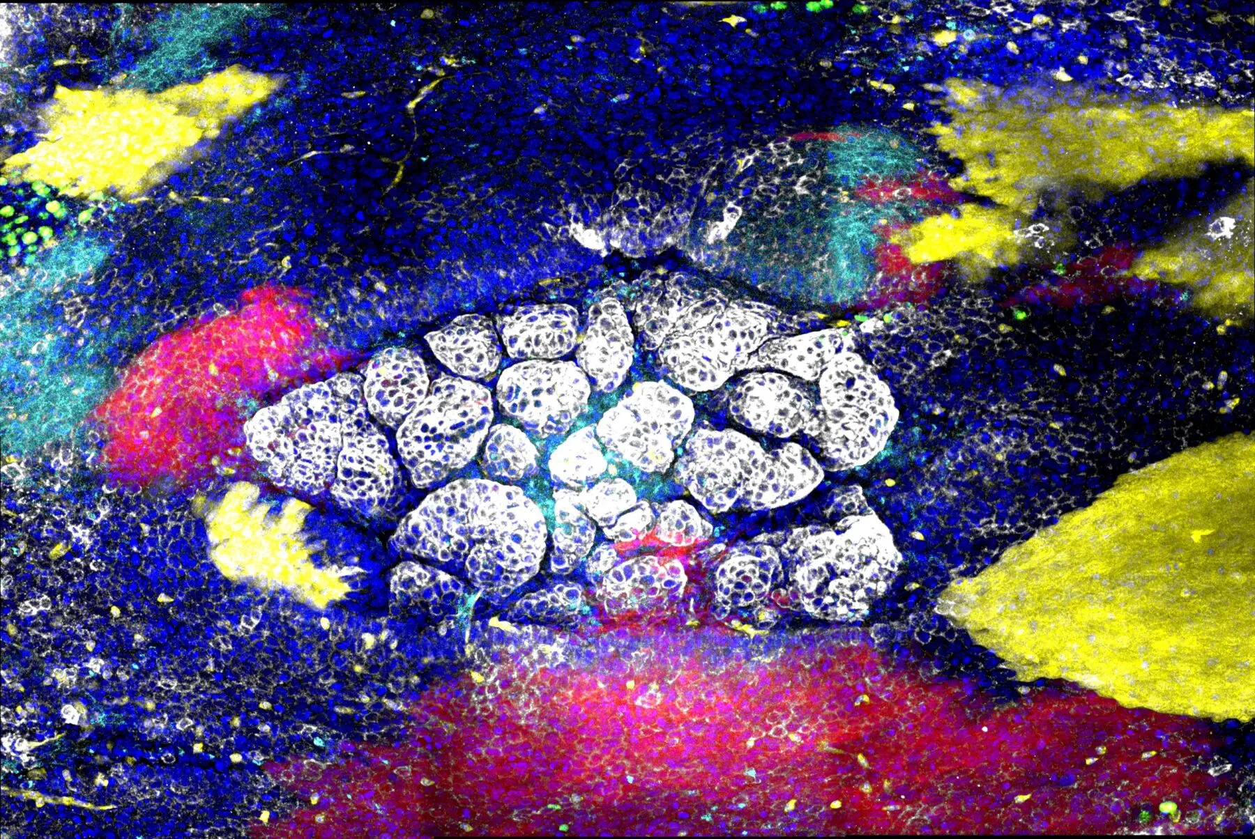 tumour during its development in the oesophagus.