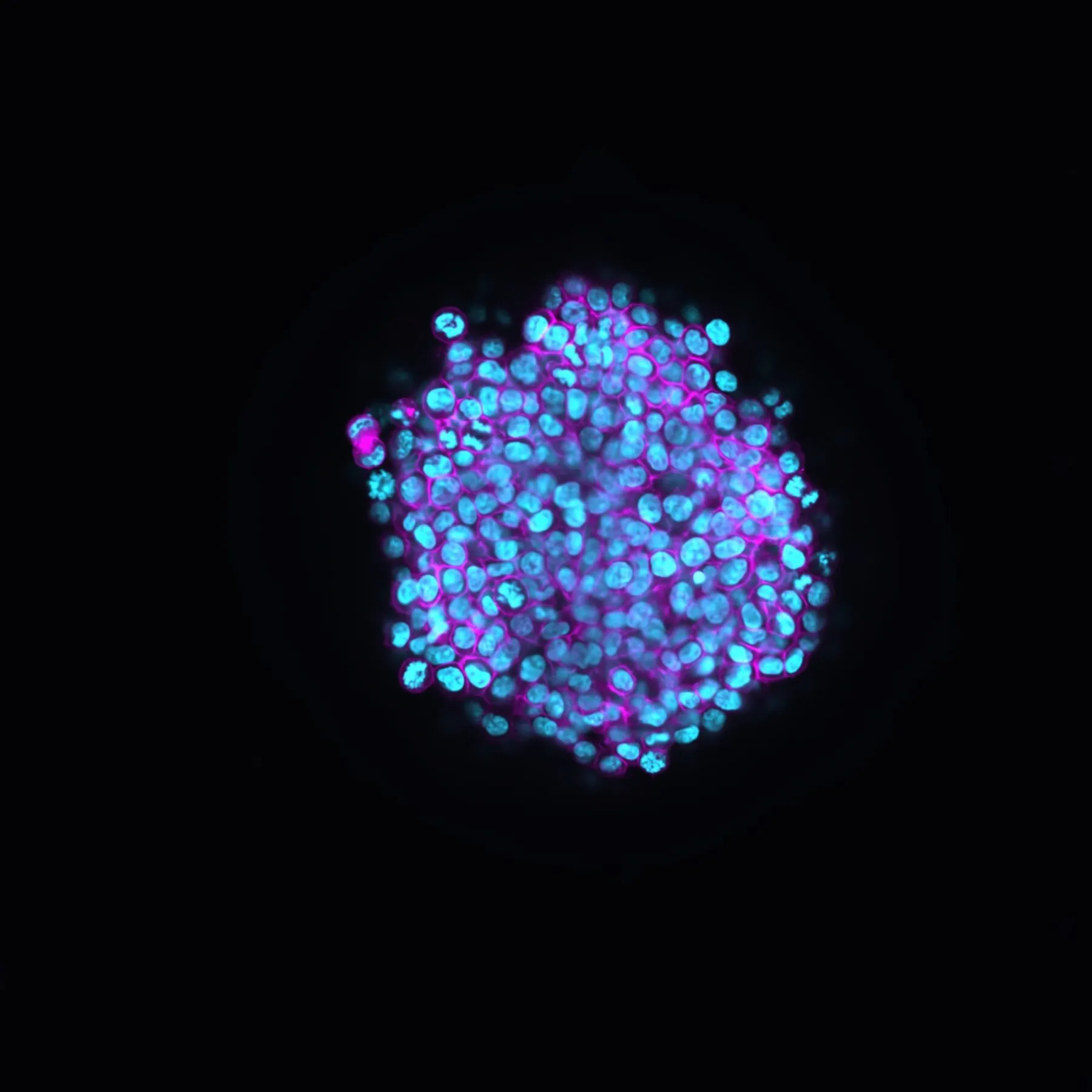 Cancer Spheroid