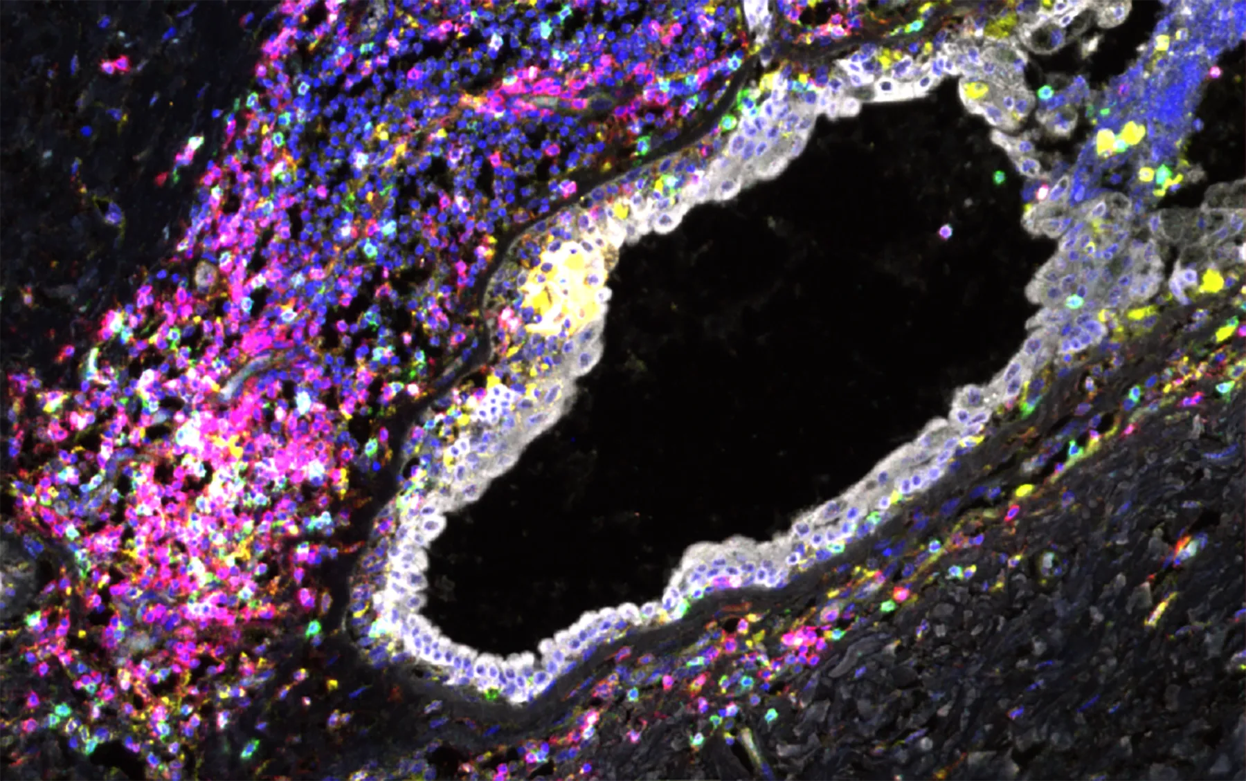 Microscopic cross section of breast tissue stained for various cell markers against a black background.