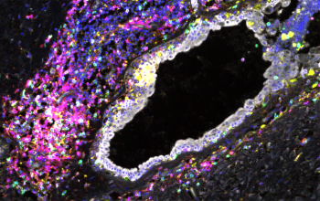 Microscopic image of human breast tissue from stained to visualise different cell markers against a black background.