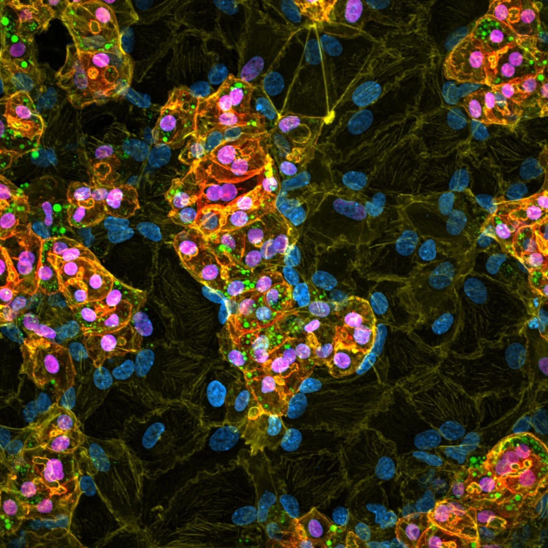 Unpicking pre-malignant fatty liver disease