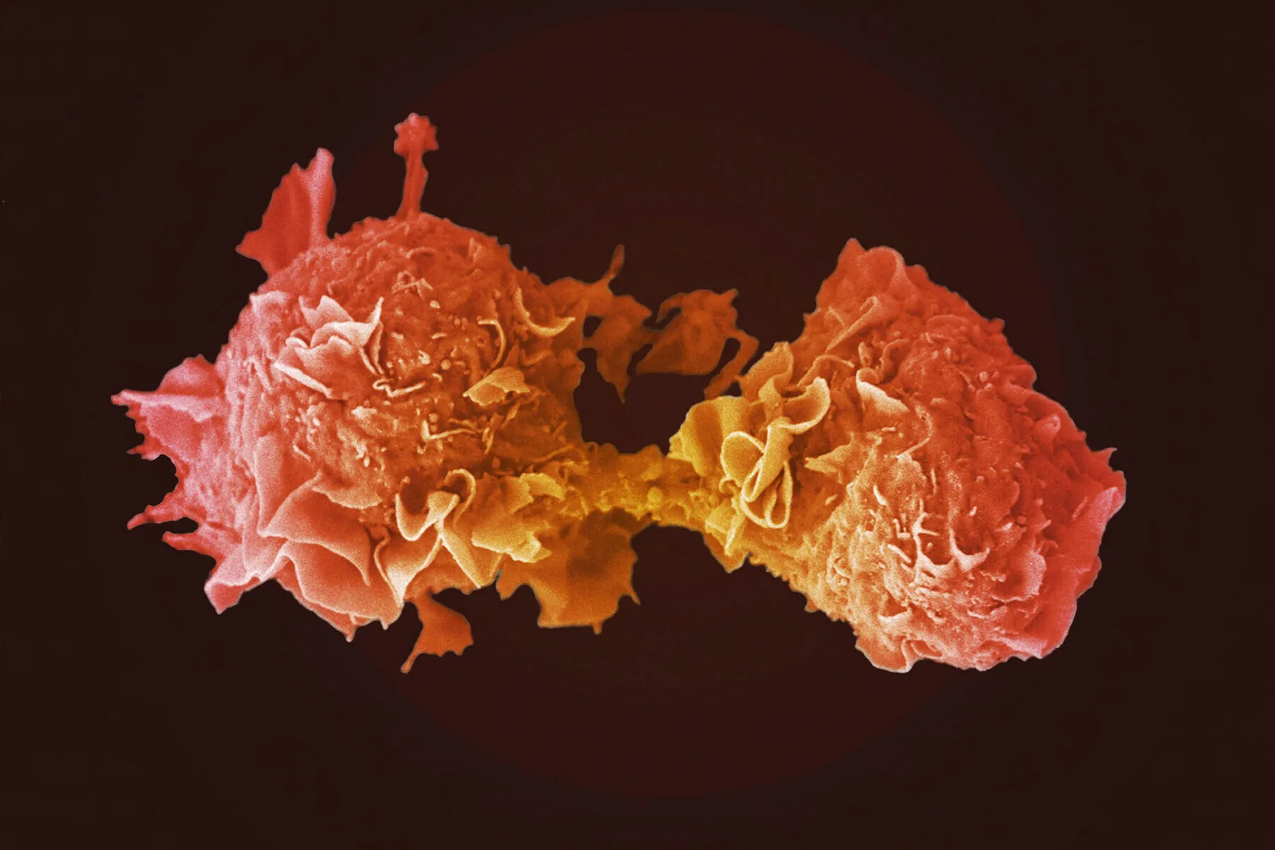 Microscopic image of an orange stained lung cancer cell dividing into two against a black background.