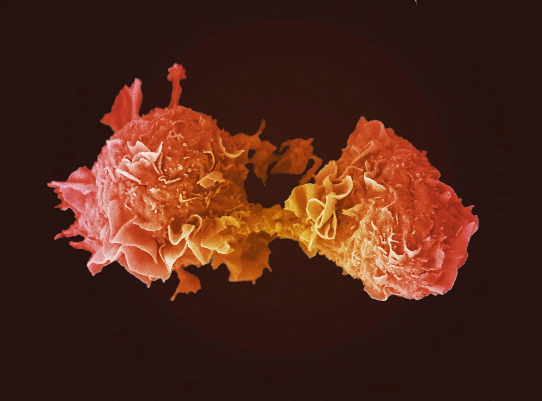 Microscopic image of an orange stained lung cancer cell dividing into two against a black background.